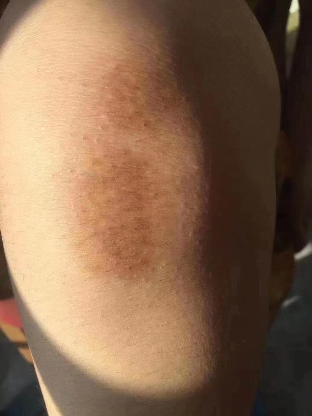 白癜风最新疗法,告别白斑困扰,重塑肌肤光彩!🌟