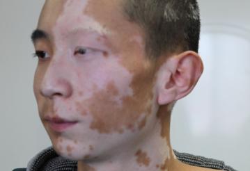 白癜风最新疗法,告别白斑困扰,重塑肌肤光彩!🌟