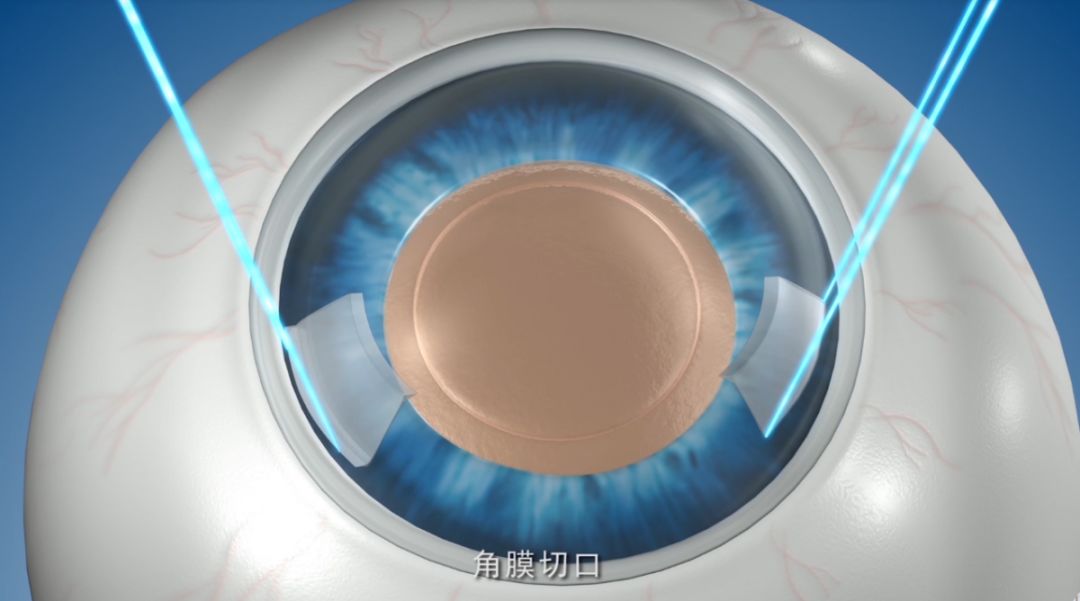 最新白内障手术视频,最新白内障手术视频，白内障手术步骤指南（初学者与进阶用户适用）