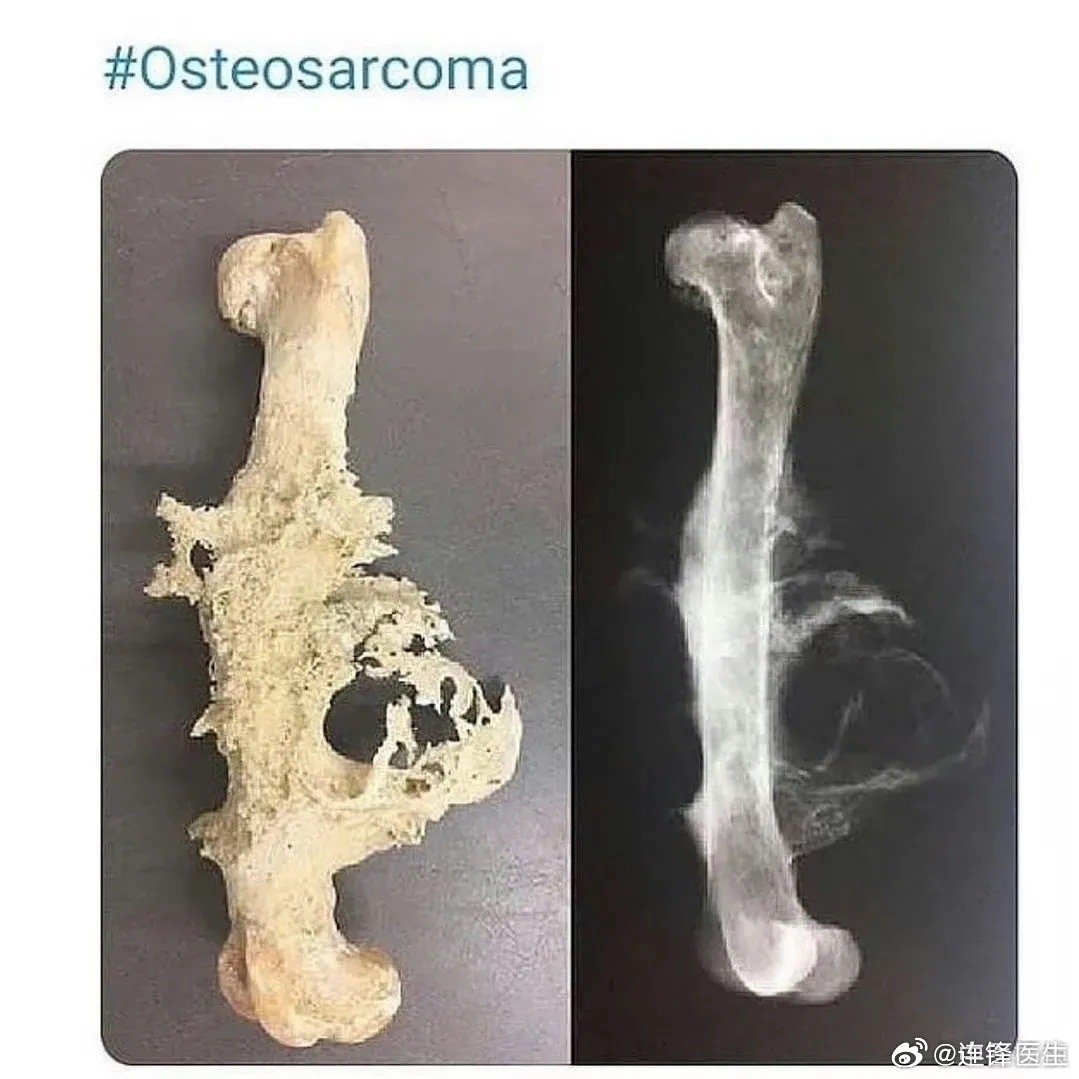 最新型骨癌,揭示疾病与友情的交织力量